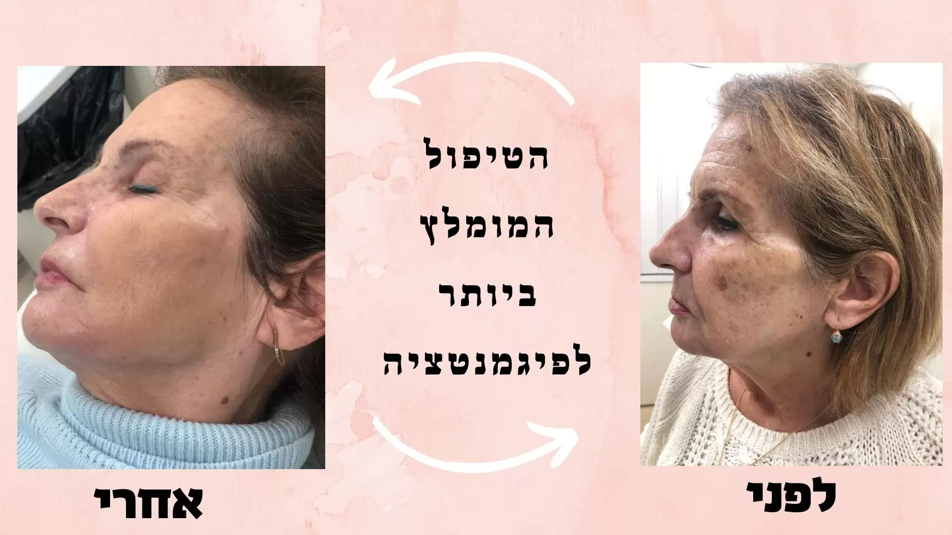 ד"ר רודניצקי - פיגמנטציה