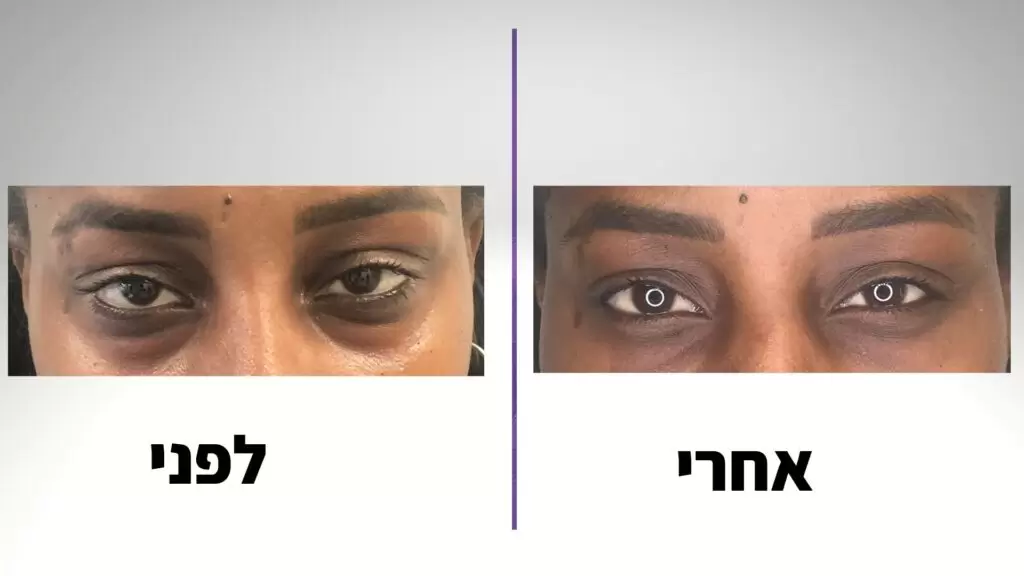 ד"ר רודניצקי - הסרת שקעים