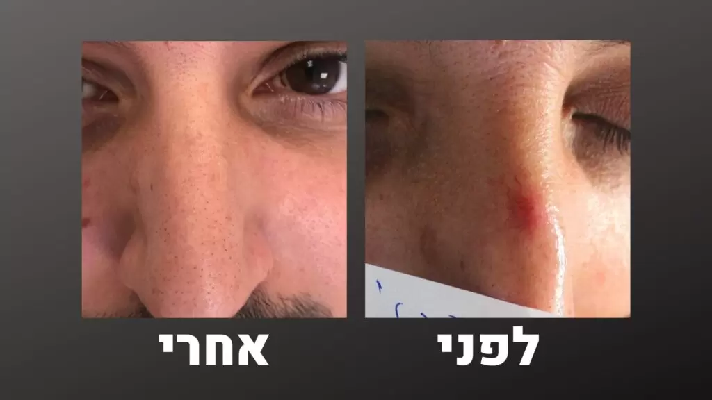 טיפול בקופרוז - נימים באף - לפני ואחרי