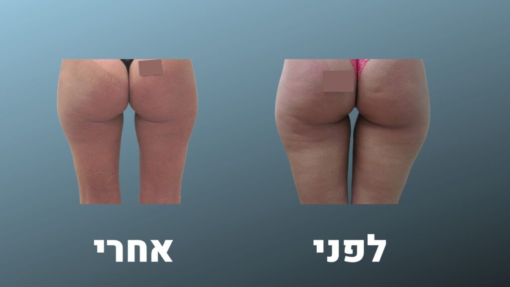 ד"ר רודניצקי - צלוליט