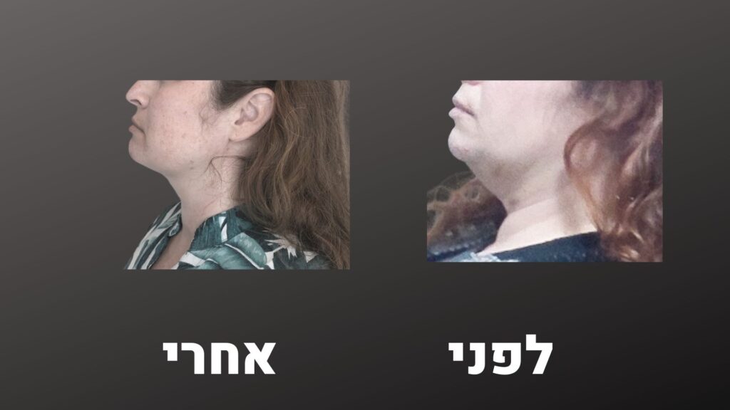 טשטוש סנטר כפול