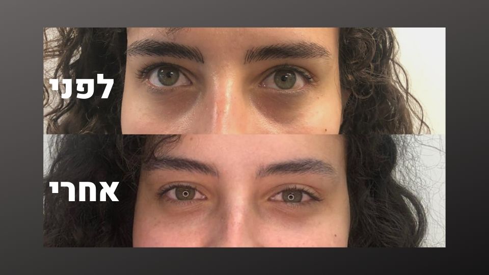שקעים מתחת לעיניים - לפני ואחרי הטיפול