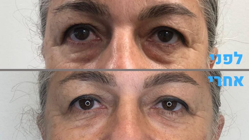 לפני ואחרי: טיפול בשקיות מתחת לעיניים