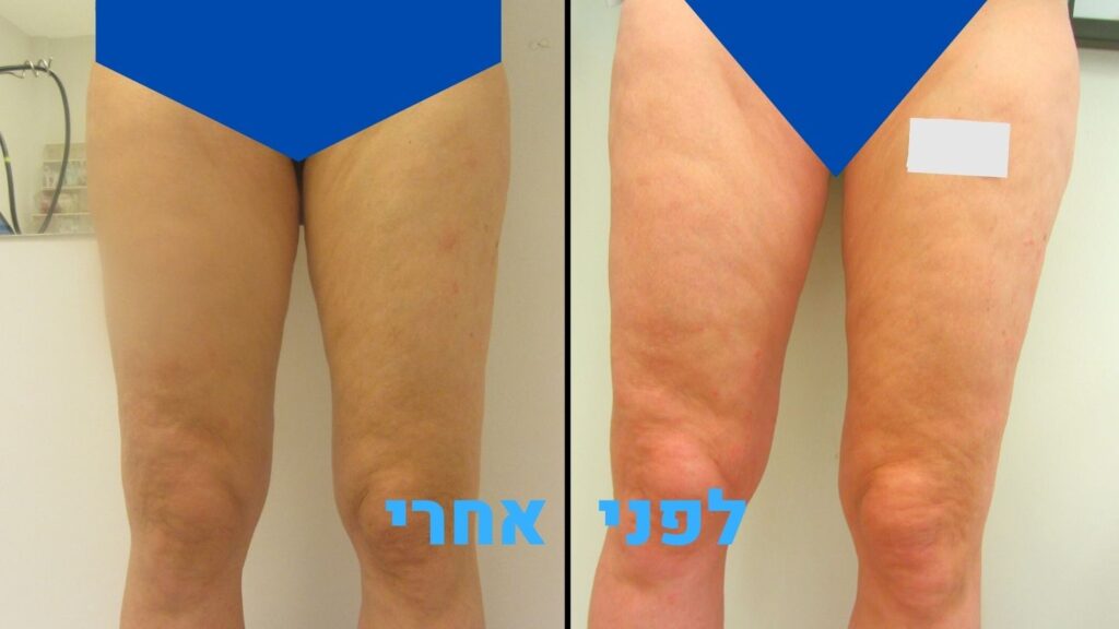 טיפול בצלוליט ברגליים - לפני ואחרי (ד"ר עודד רודניצקי)