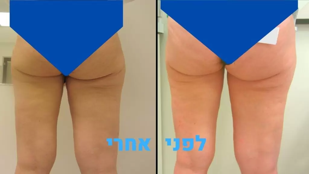לפני ואחרי טיפול צלוליט ברגליים