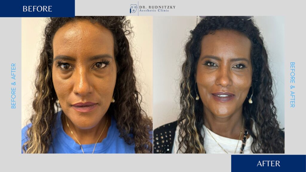 לפני ואחרי - טיפול בשקעי עיניים ומילוי שפתיים