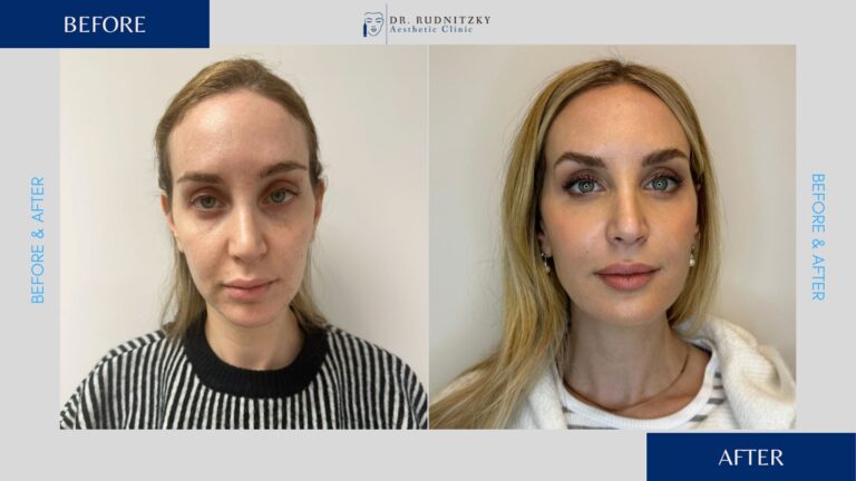לפני ואחרי טיפולי פנים שונים