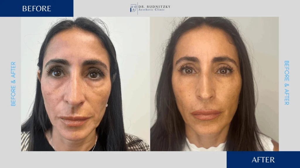 שקיות מתחת לעיניים - לפני ואחרי