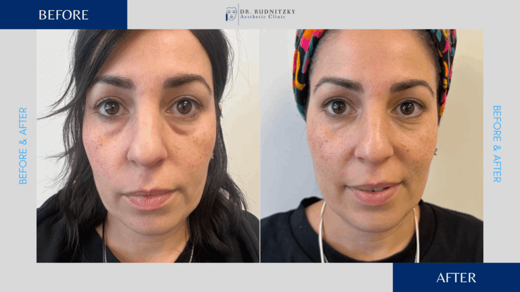 שקיות מתחת לעיניים - לפני ואחרי