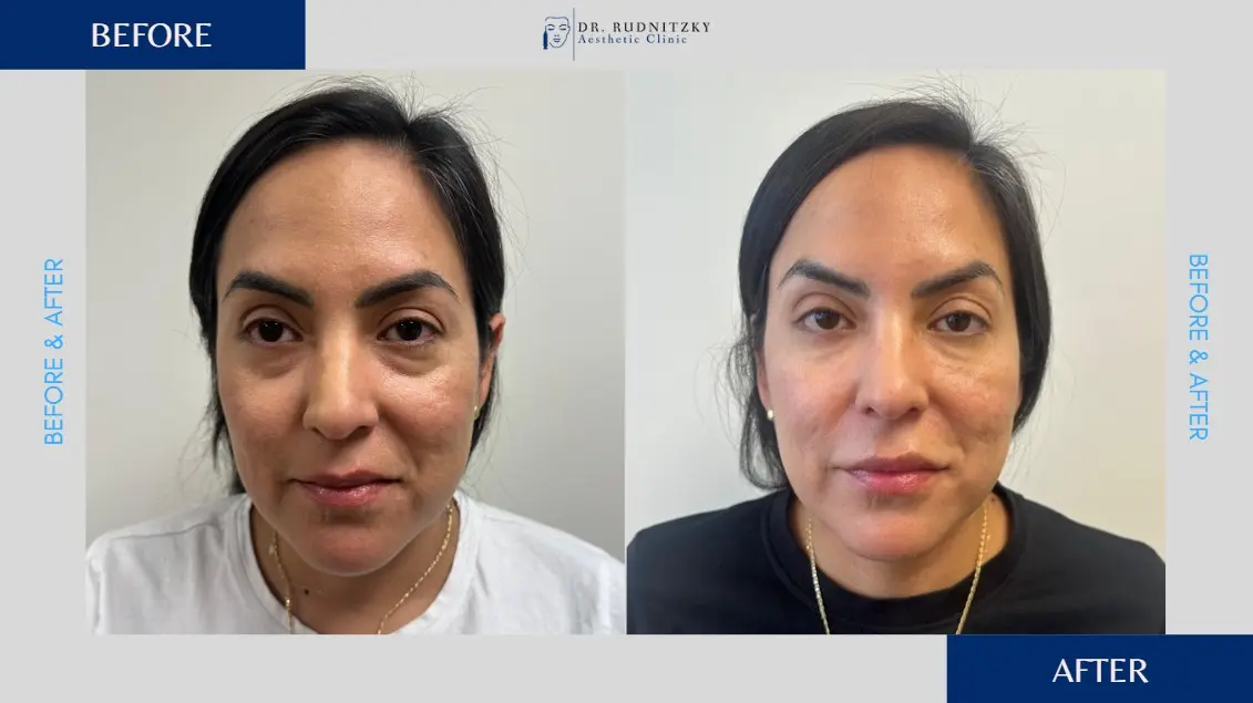 איך מטפלים בשקיות מתחת לעיניים?