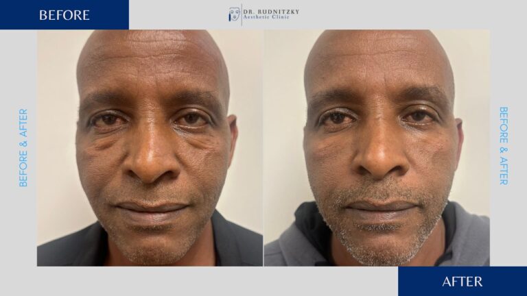 העלמת שקיות מתחת לעיניים - לפני ואחרי