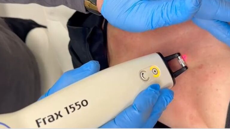 מיצוק עור המחשוף (דקולטה) - צילום מתוך הטיפול - ד"ר עודד רודניצקי