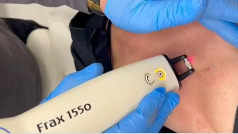 מיצוק עור המחשוף (דקולטה) - צילום מתוך הטיפול - ד"ר עודד רודניצקי