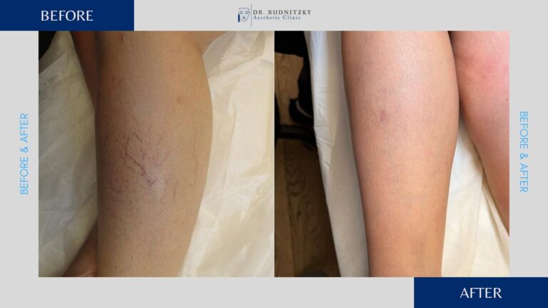 העלמת נימים בלייזר לפני ואחרי