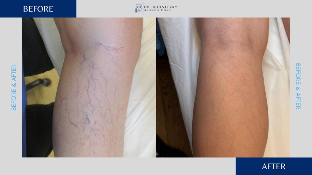 העלמת נימים בלייזר לפני ואחרי