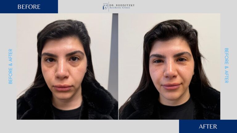 לפני ואחרי מילוי שקעים מתחת לעיניים