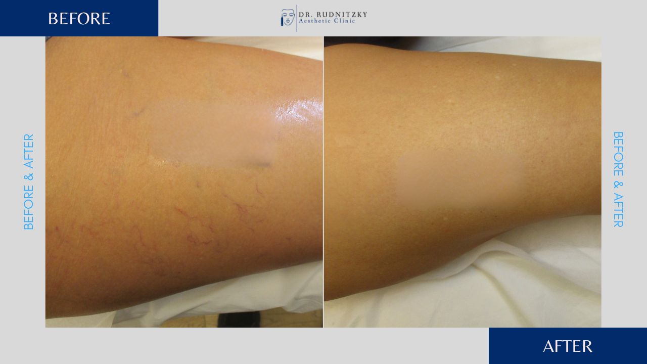 העלמת נימים ברגליים לפני ואחרי - ד"ר עודד רודניצקי