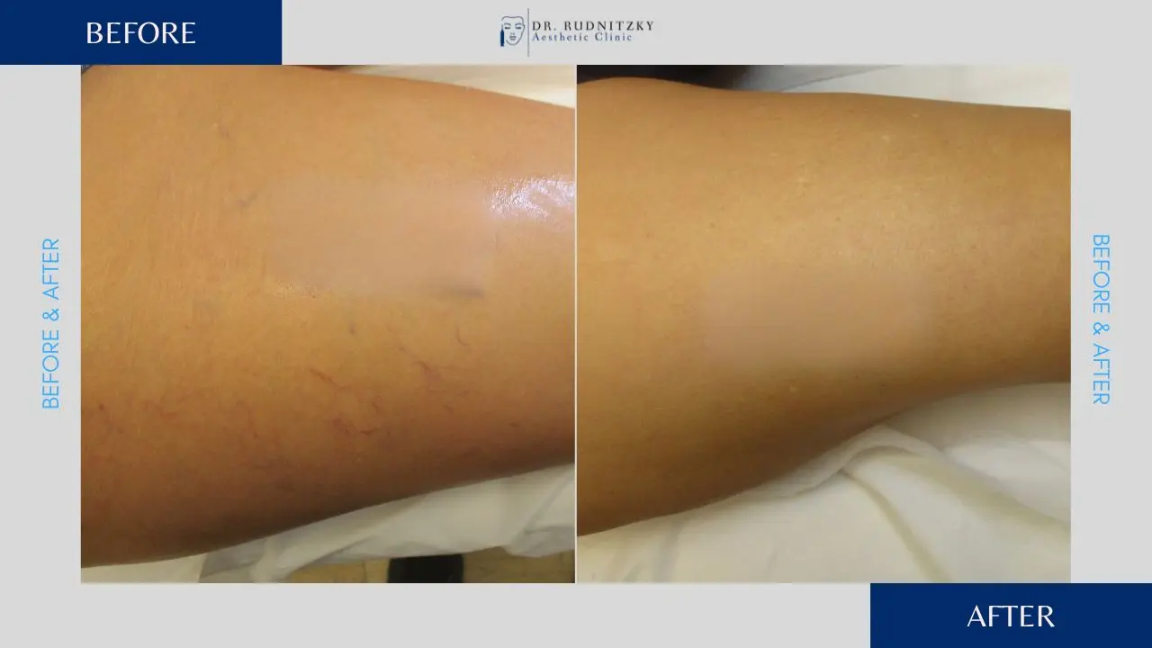 העלמת נימים ברגליים לפני ואחרי - ד"ר עודד רודניצקי