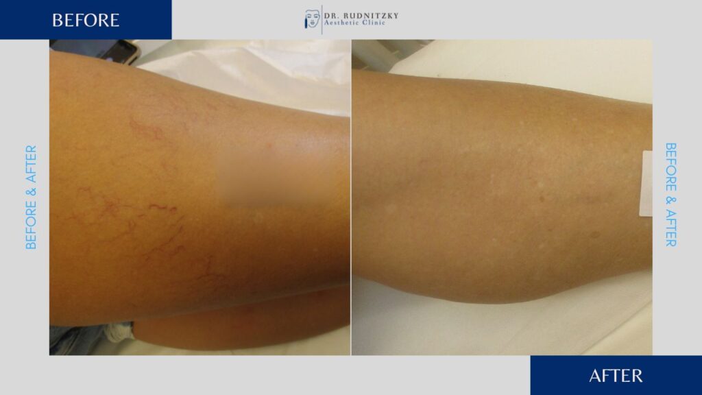 נימים ברגליים לפני ואחרי - ד"ר עודד רודניצקי