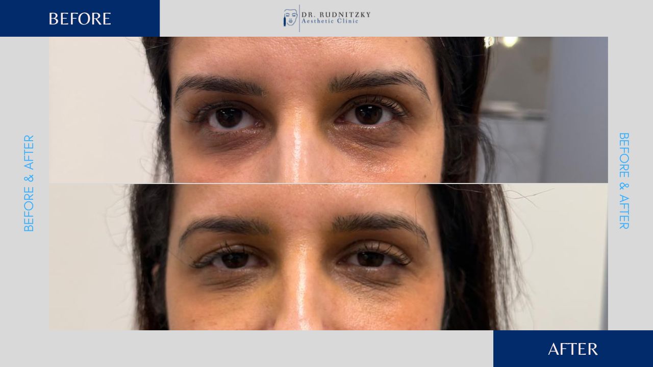 שקעי עיניים - לפני ואחרי מילוי שקעים מתחת לעיניים